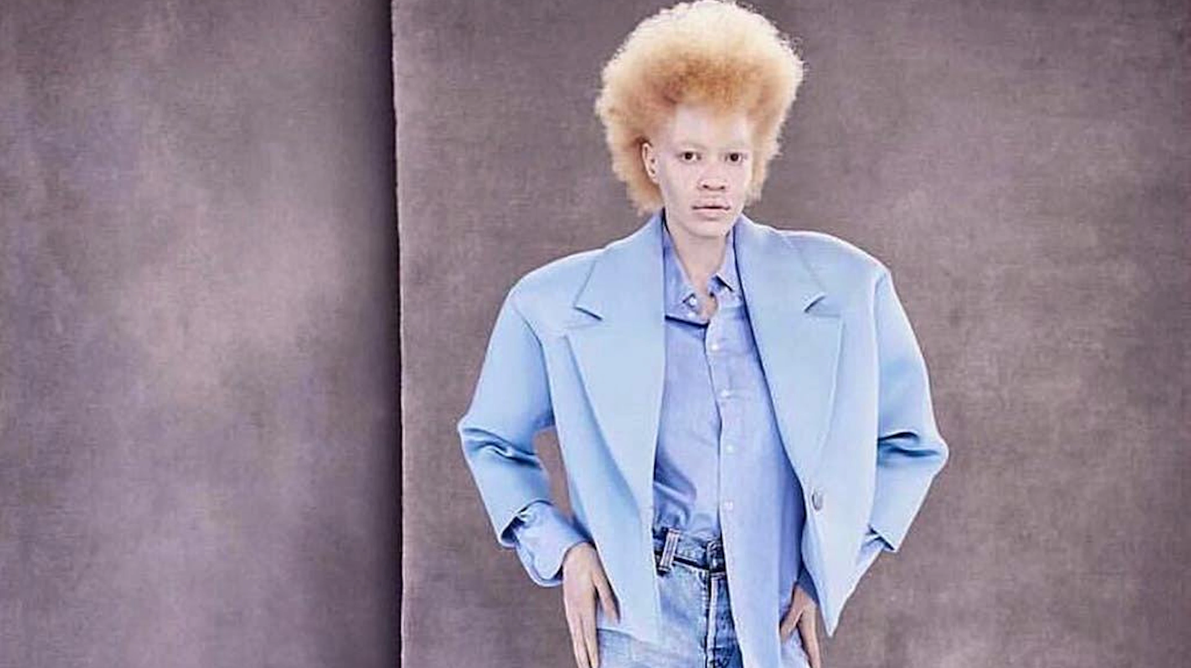 Diandra ist Afro-Amerikanerin und hat sehr unter ihrem Albinismus gelitten.