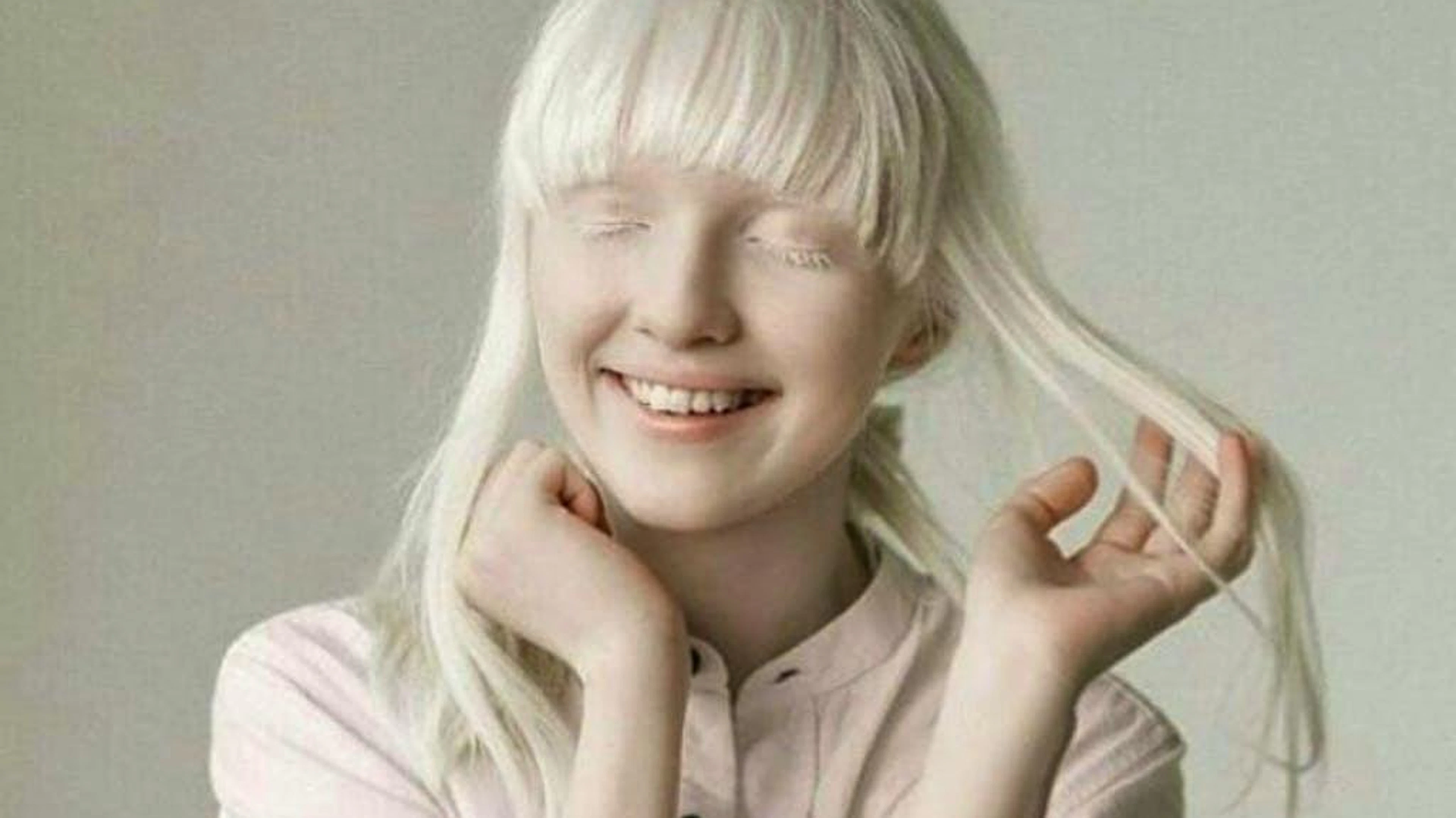 Nastya Zhidkova hat Albinismus.