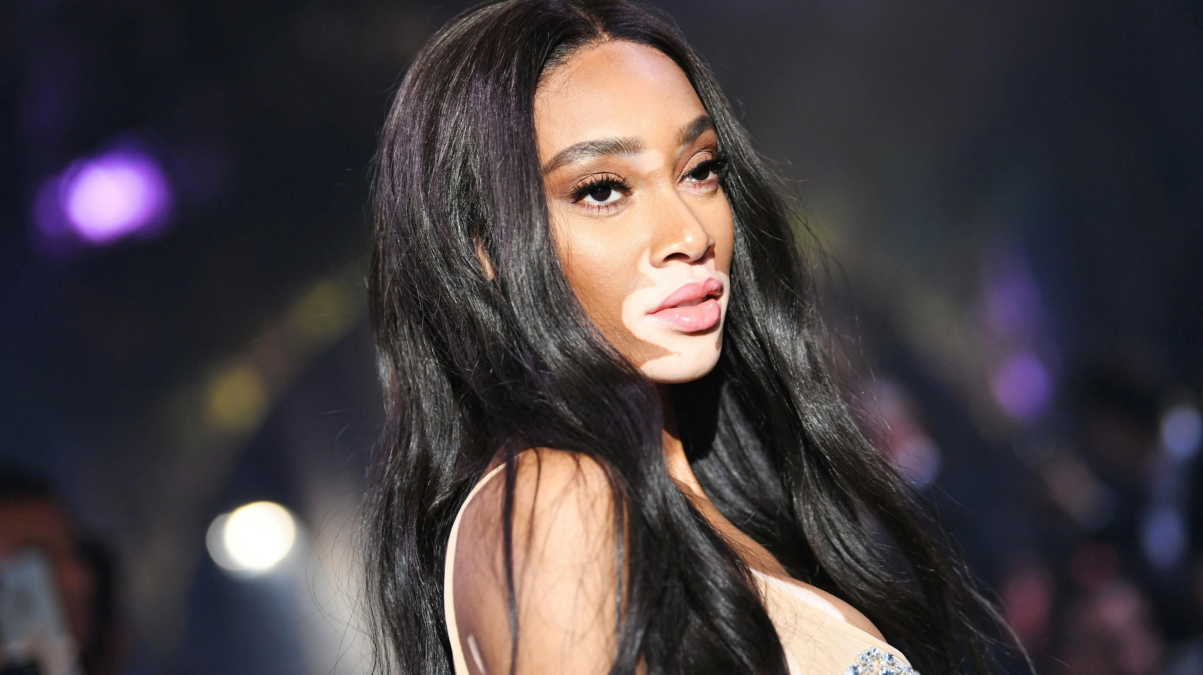 Sie läuft als Victoria's Secrets Engel über den Laufsteg – will sich aber nicht auf ihre Hautkrankheit reduzieren lassen.