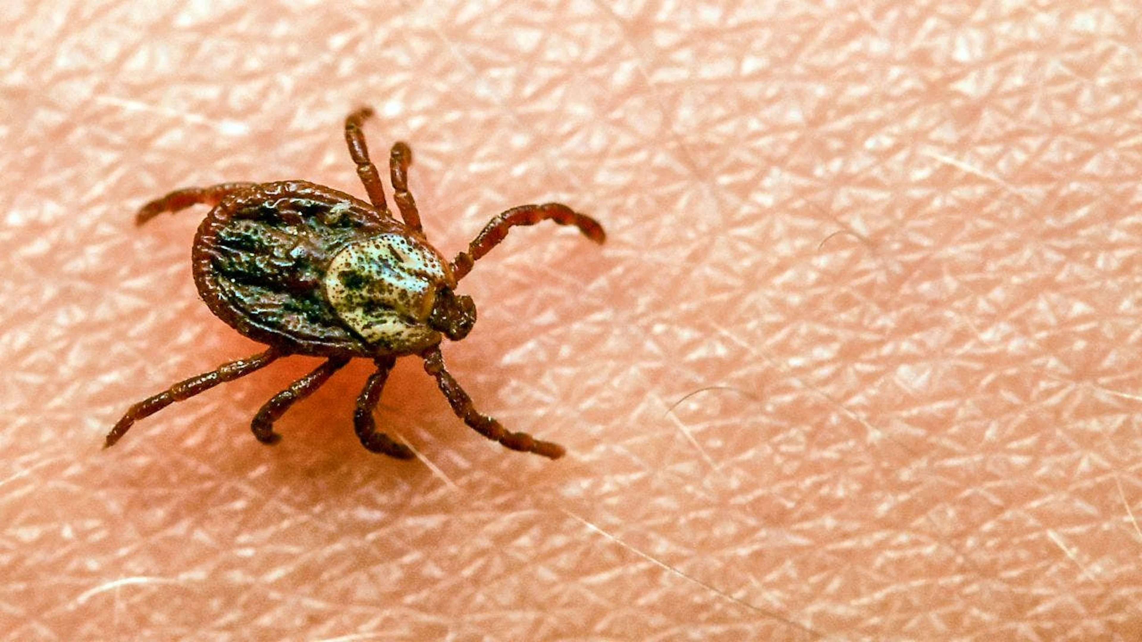 Das durch Zecken übertragene FSME-Virus kann eine Hirnhautentzündung verursachen. (Archivbild)