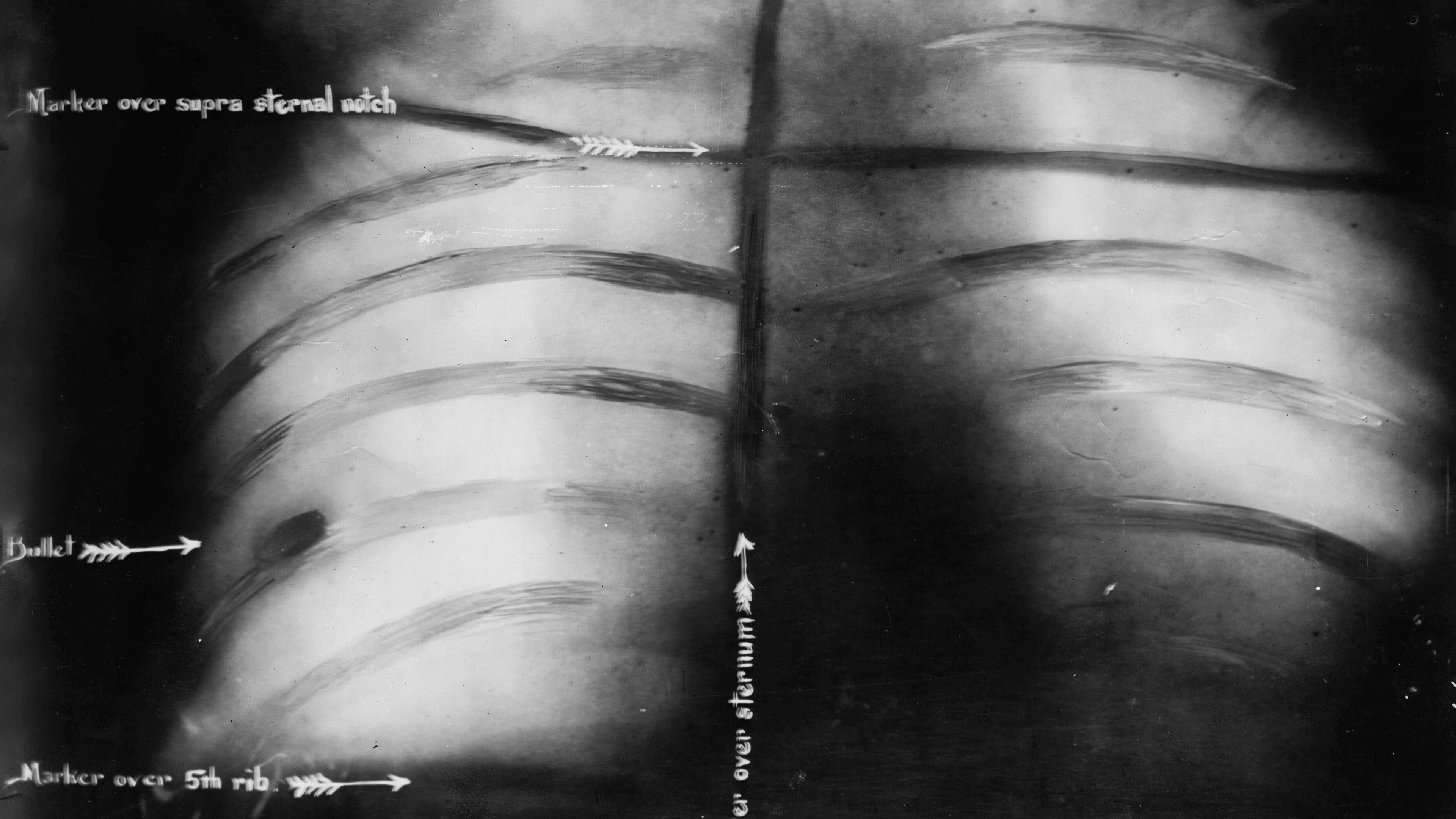 1912: Theodore Roosevelt - survived: This X-ray shows Roosevelt's chest after the attempted assassination in October 1912. "Teddy", as Roosevelt was also known, is attacked in Milwaukee shortly before an election campaign appearance. By this time, he had already served two terms as president and was running again as an independent candidate. Roosevelt is not seriously injured: a spectacle case and the folded manuscript of his speech muffle the shot. The perpetrator, John Schrank, is arrested and spends the rest of his life in psychiatric hospitals.