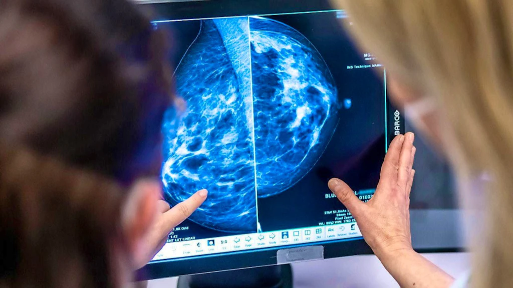 Artificial intelligence improves breast cancer screening according to study