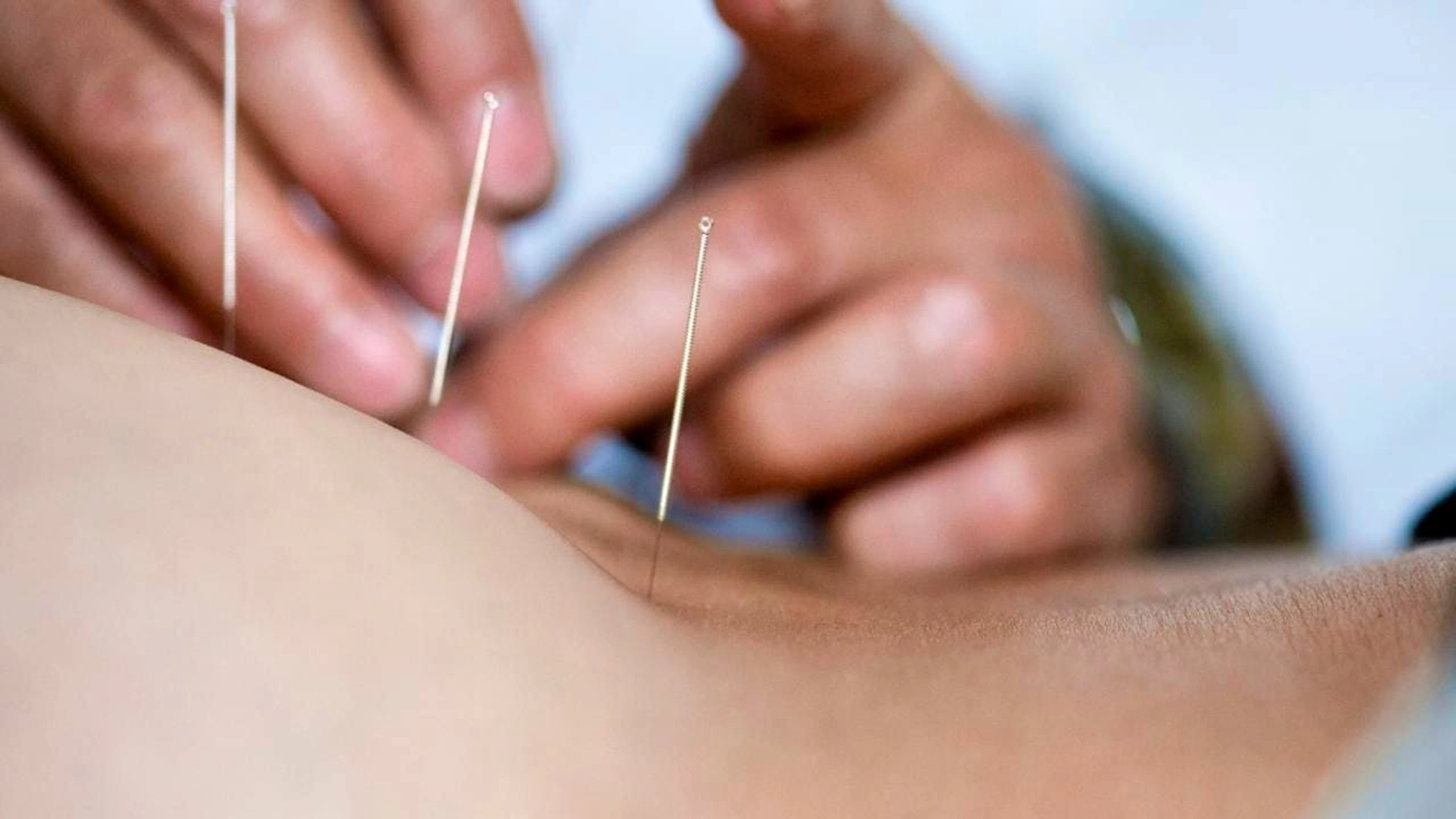 Les Suisses continueront de participer au financement de l'acupuncture via l'assurance de base (archives).