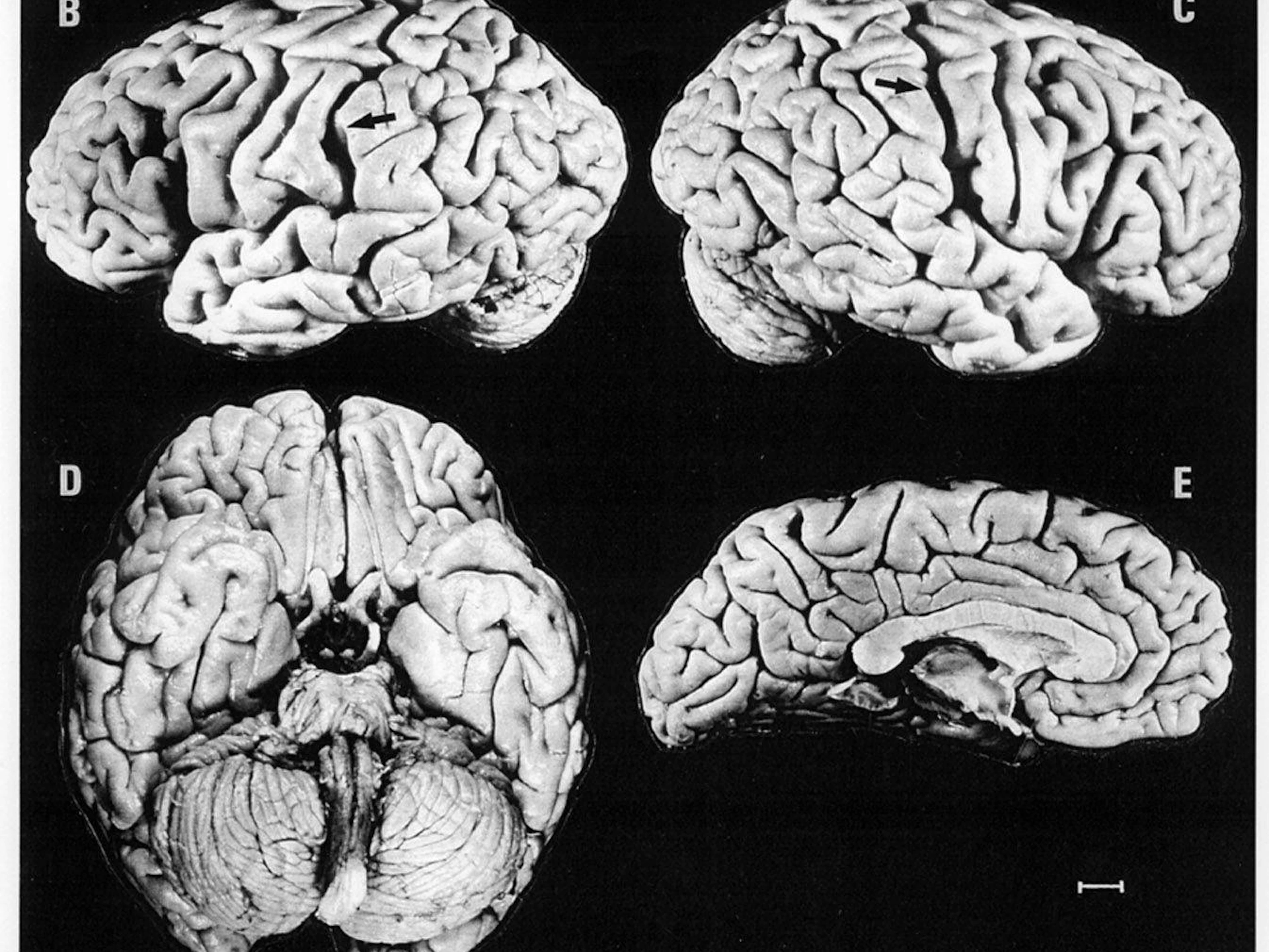 Albert Einsteins Hirn wurde zu Forschungszwecken in 240 Teile zerschnitten. Erst seit kurzer Zeit weiss man, dass sein Gehirn nicht gewöhnlich war. Gewisse Stellen waren viel ausgeprägter als bei einer durchschnittlichen Person. 