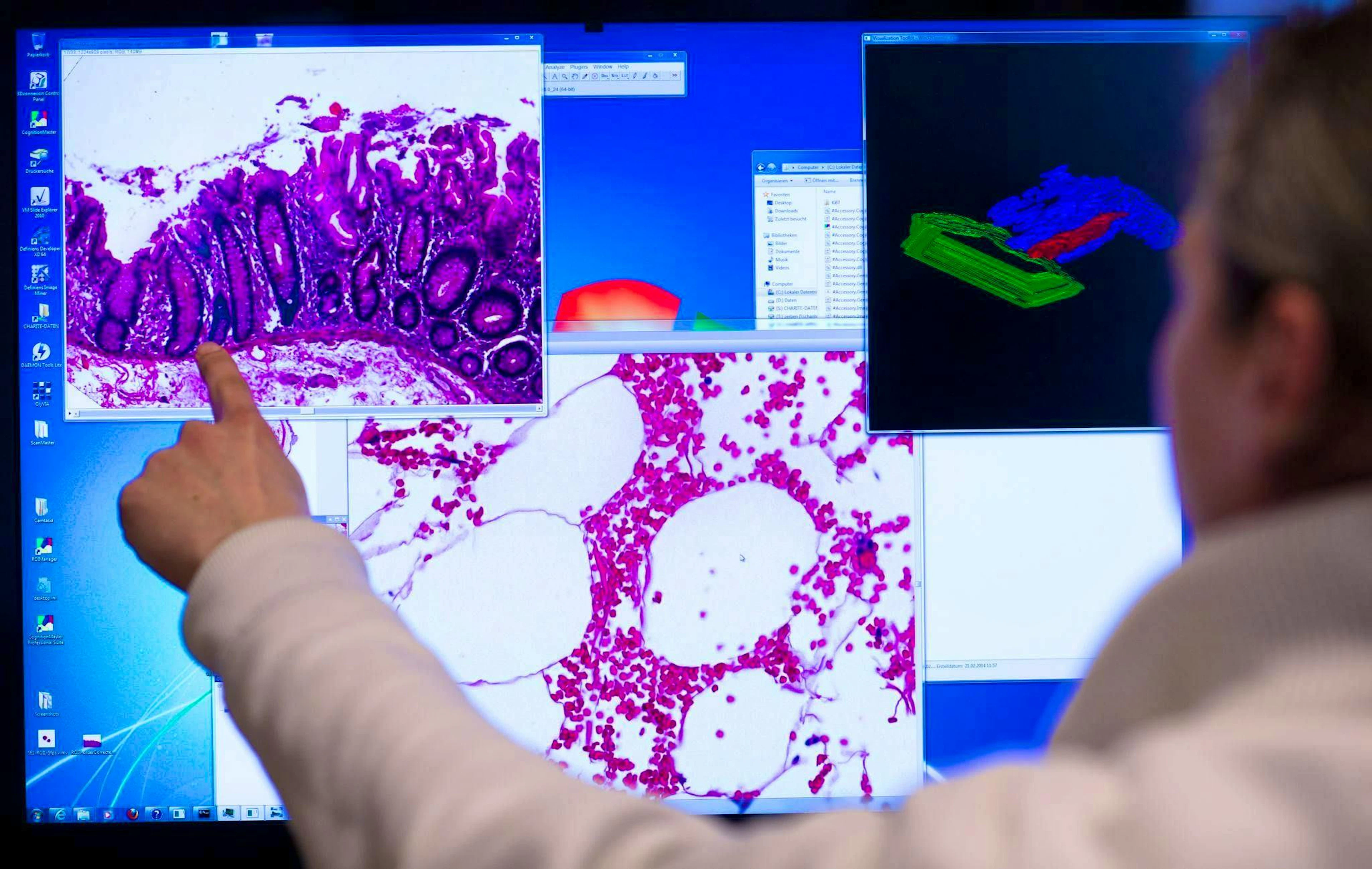 Colorectal cancer is to be detected earlier.