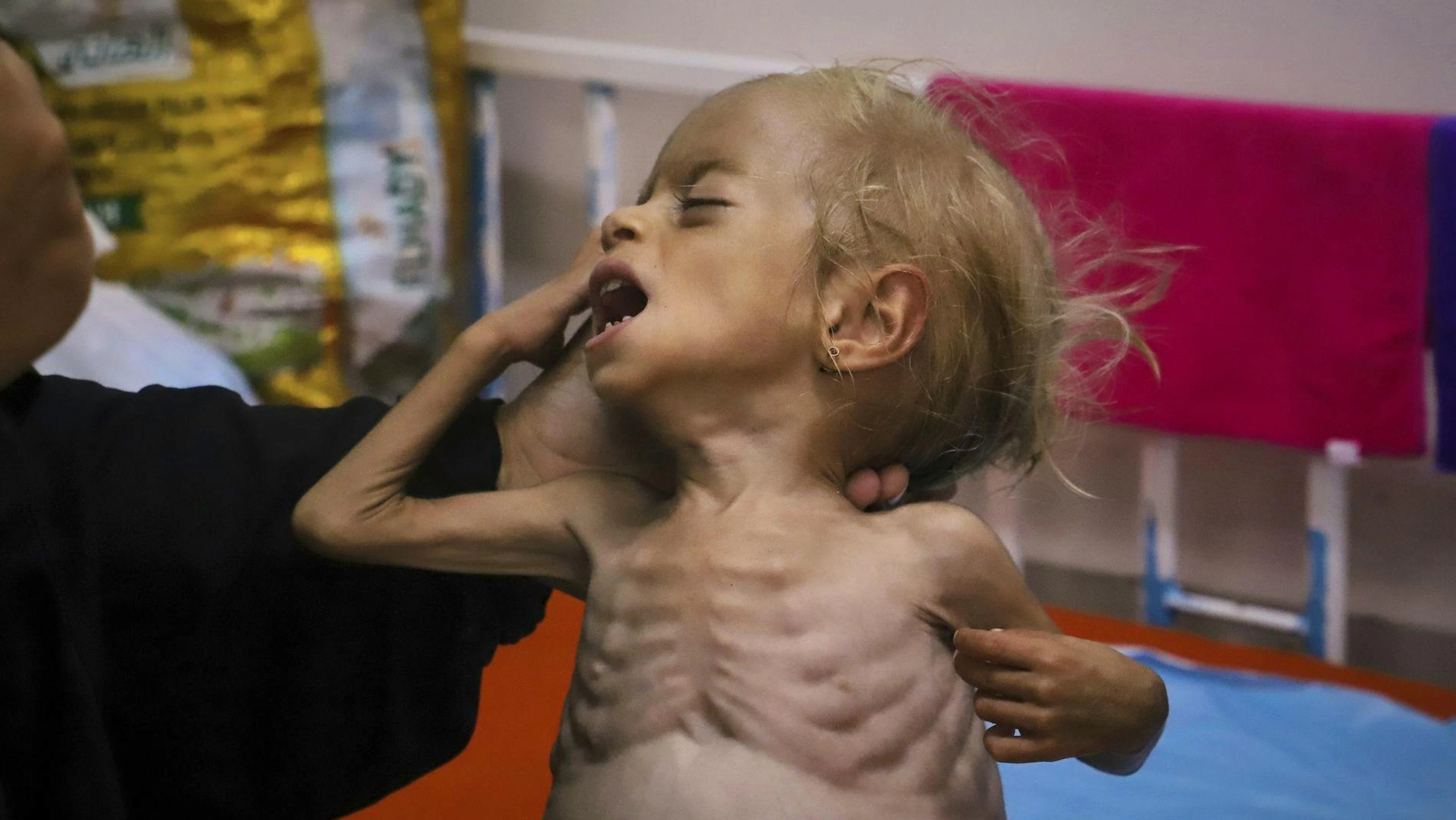 Islam Qudeih montre sa fille Shamm, âgée de 2 ans, souffrant de malnutrition sévère et torse nu, aux journalistes à l'hôpital Nasser de Khan Younis, dans le sud de la bande de Gaza, le samedi 9 août 2025. Les médecins ont déclaré que Shamm souffrait peut-être d'une maladie génétique affectant le développement musculaire et osseux, mais qu'il n'existait aucun moyen de la dépister à Gaza. Le mardi 12 août, sa famille a obtenu l'autorisation de se rendre dans un hôpital en Italie. (AP Photo/Mariam Dagga)