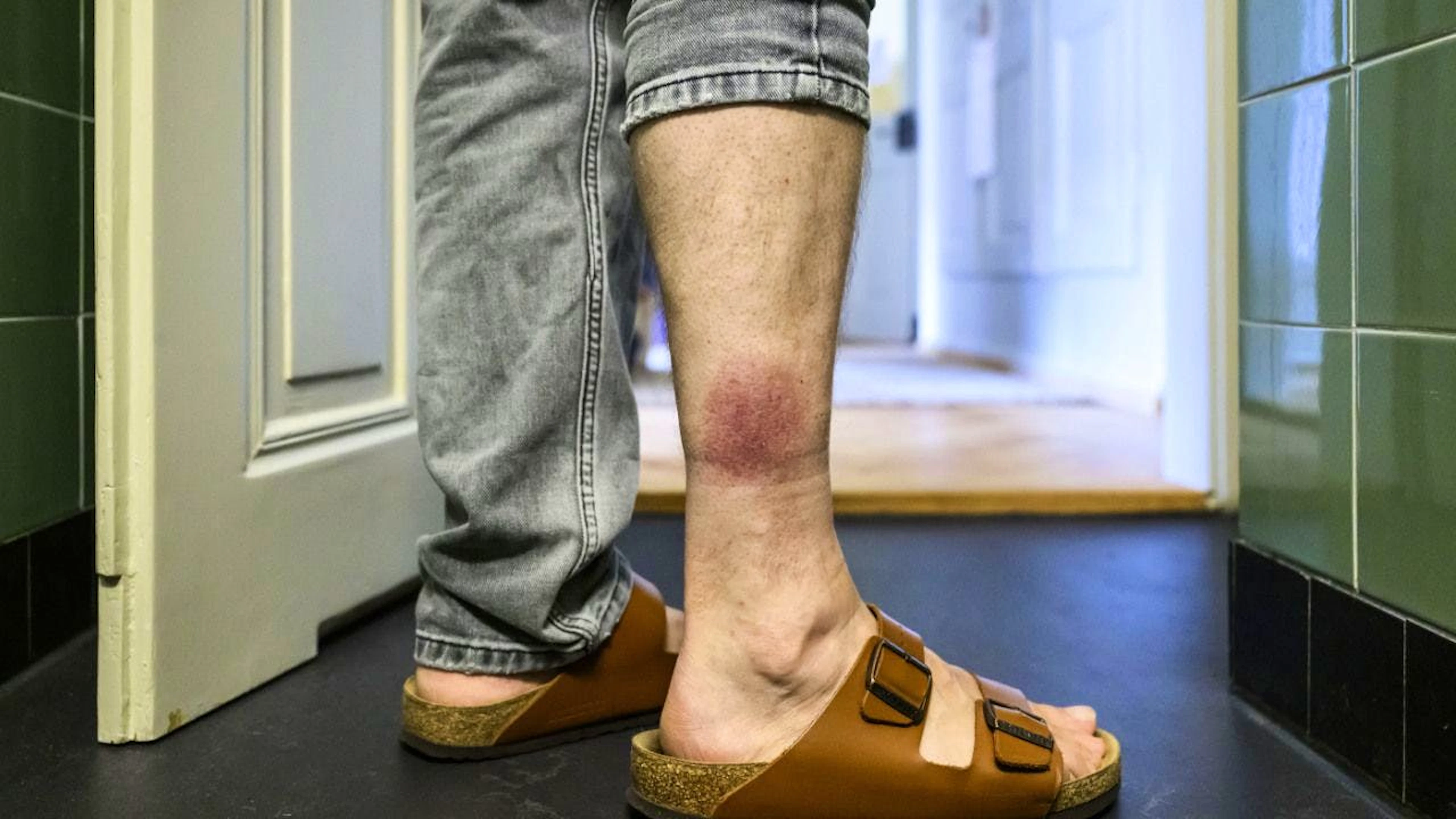 Die Suva empfiehlt, nach einem Zeckenstich bei Symptomen wie einer sich ausbreitenden Rötung, Fieber oder Kopfschmerzen eine Ärztin oder ein Arzt aufzusuchen. (Archivbild)