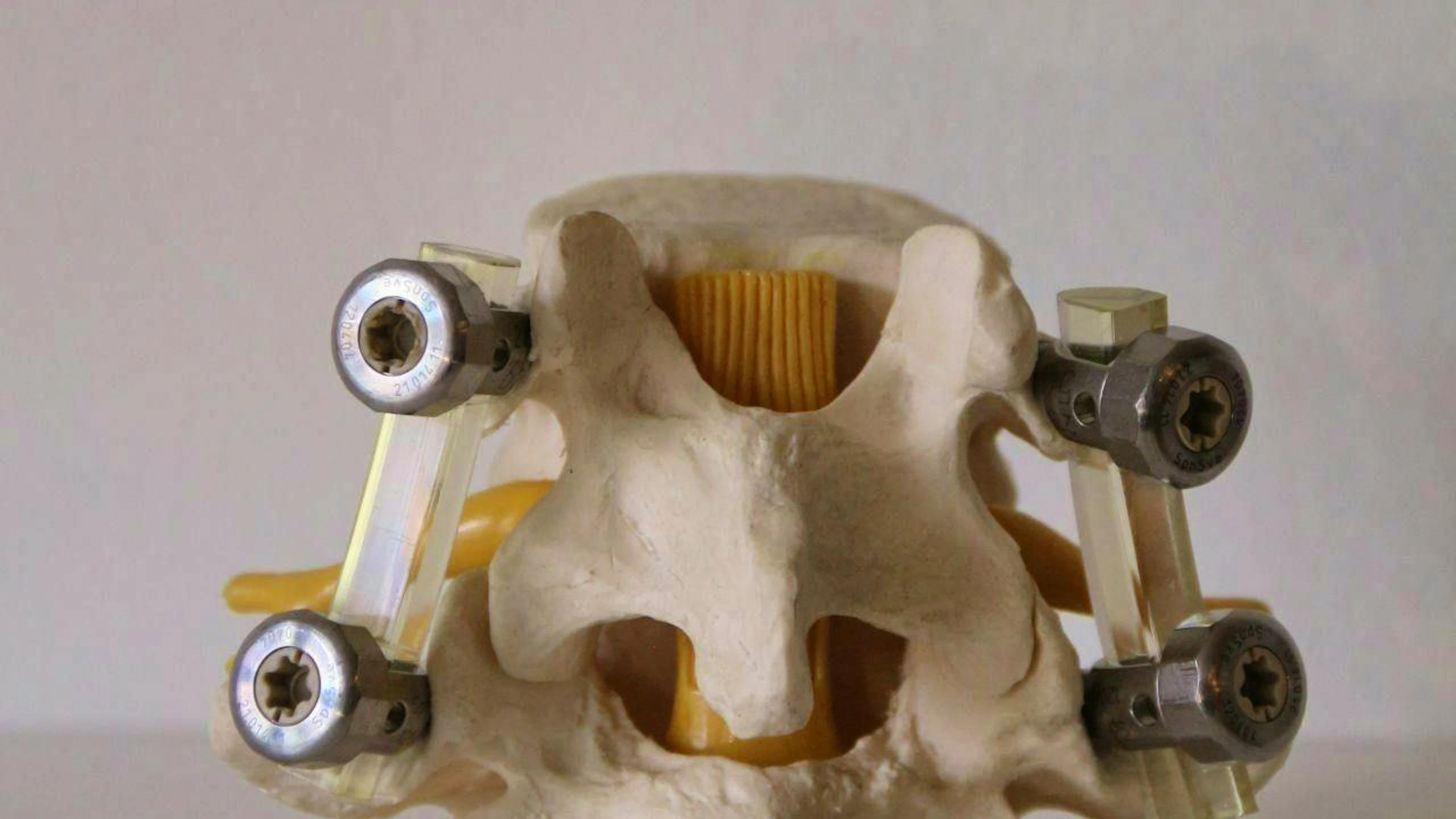 Medical screws for the spine.