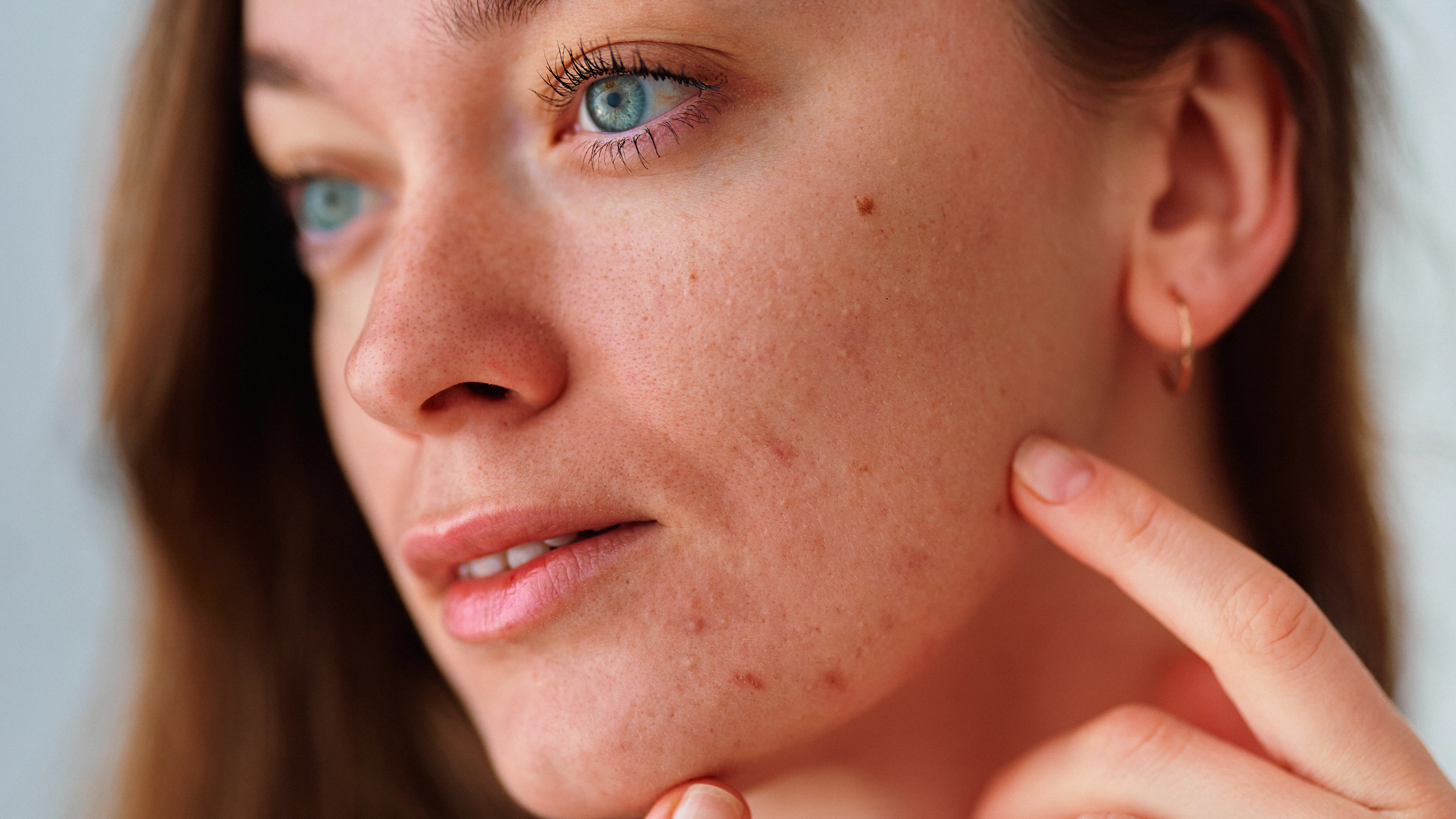 L'acné est également un problème qui tend à s'aggraver en période de stress.