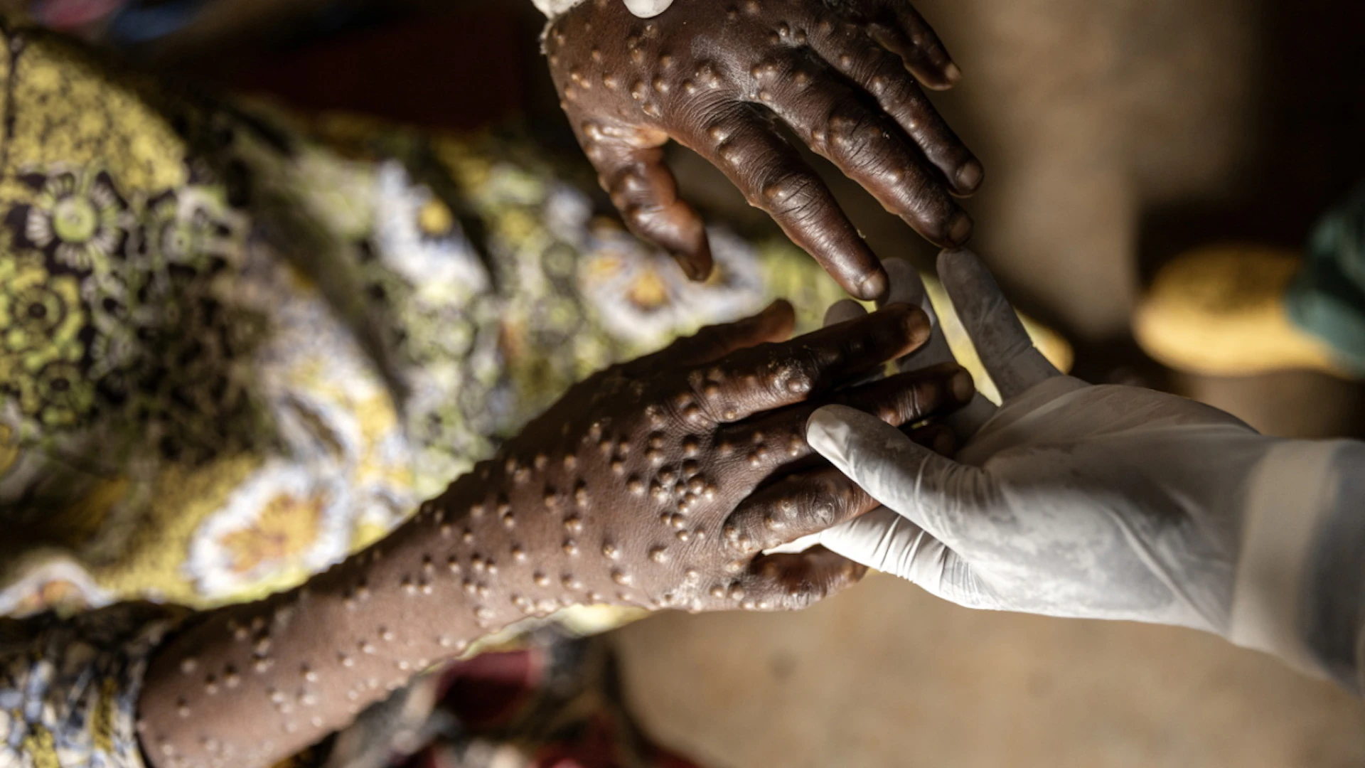 Mpox en RDC : plus d'un tiers des cas positifs seraient de faux diagnostics